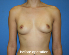 plastic-surgery-breast-augmentation